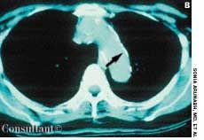 Calcification of the Mediastinum Following Tuberculosis