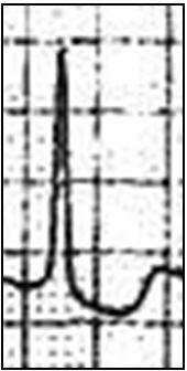 ECGs Make for Fascinating Reading: A Photo Essay