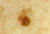 Severely Dysplastic Junctional Nevus