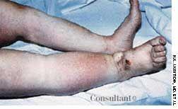 Milroy's Disease