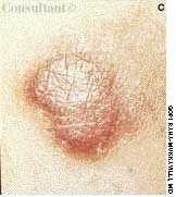 Kaposi's Sarcoma