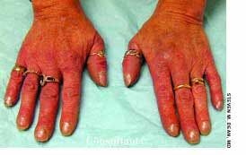 Anorexia Nervosa-Associated Raynaud Phenomenon