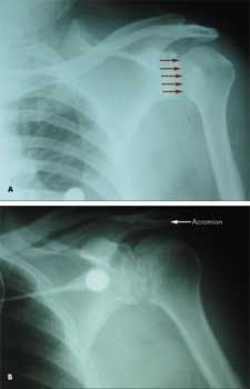 Posterior Shoulder Dislocation