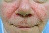 Seborrheic Dermatitis