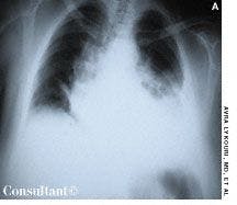 Traumatic Hemothorax