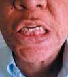 Gingival Hyperplasia