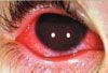 Conjunctivitis, Iritis, Fused Lids, and More: Photo Essay of Eye Disorders