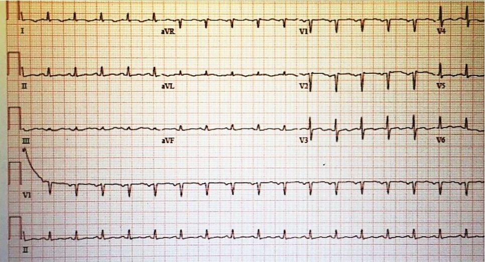 Tachycardia, SOB in a 37-year-old Man with HIV/AIDS