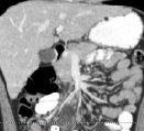 Lower Quadrant Pain and Emesis in a Young Boy 