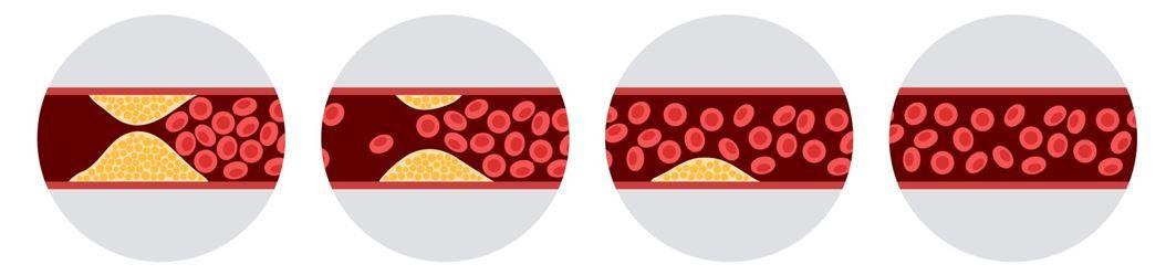 ASCVD Risk Reduced by 10% with Diet, Greater Drops Seen in Women, Black Adults