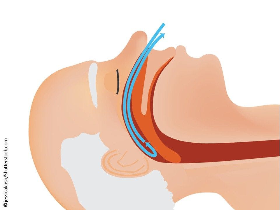 Patients with Severe OSA at Two-fold Higher Risk for Sudden Death, New Study Shows 