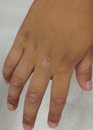 Myopathy Followed by Rash in a Young Boy: Classic Signs?