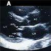 Serotogenic Multivalvulopathy With Regurgitations