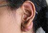 Keloid Associated With Ear Piercing