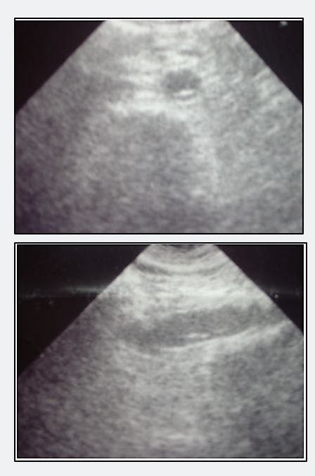 Epigastric Pain, Otherwise Healthy  