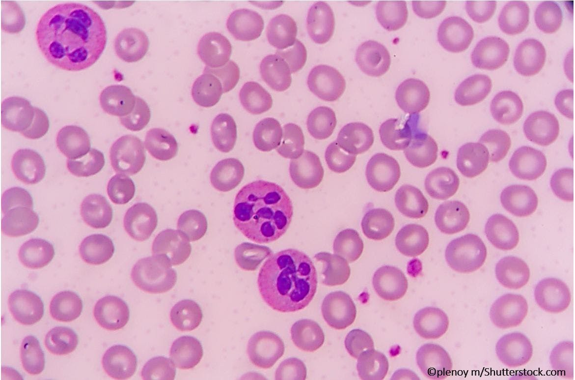 Weakness, DOE, and WBC > 100K: What's Your Diagnosis? 