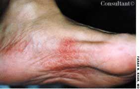 Stevens-Johnson Syndrome Due to Levofloxacin Hypersensitivity