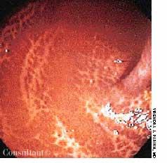 Melanosis Coli