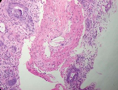 Schistosoma mansoni Colitis in an AIDS Patient