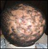 Dissecting Cellulitis of the Scalp