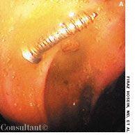 Infantile Perianal Pyramidal Protrusion