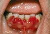 Scurvy: Easy Bruising and Bleeding Gums