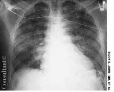 Neurogenic Pulmonary Edema