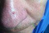 Seborrheic Keratosis Removed Using Shave Biopsy