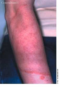 Steroid-Exacerbated Tinea Corporis