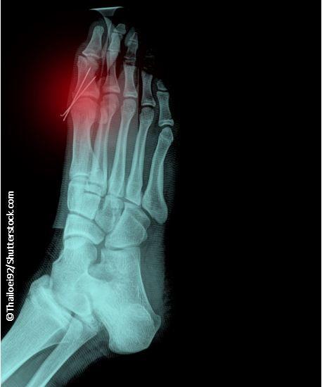 Risk of Atrial Fibrillation is Associated with Gout 