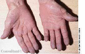 Palmar Erythema