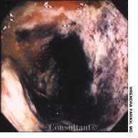 Severe Ischemic Colitis