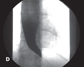 “Bird’s beak” appearance of the distal esophagus, confirming achalasia. 