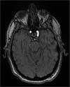 Nonarteritic Anterior Ischemic Optic Neuropathy