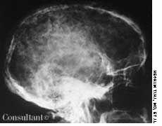 Multiple Myeloma