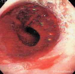 Diffuse Gastric Polyposis in a 47-Year-Old Woman