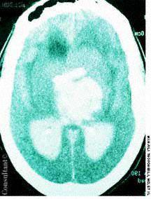 Intracerebral Hemorrhage