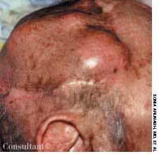 Metastases to the Scalp