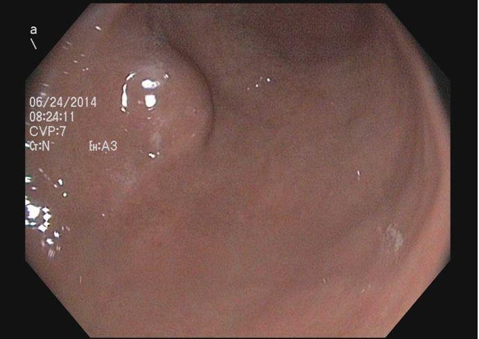 Subepithelial lesion in the antrum 