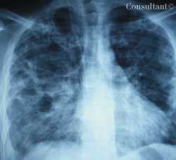 Cryptococcus neoformans Infection