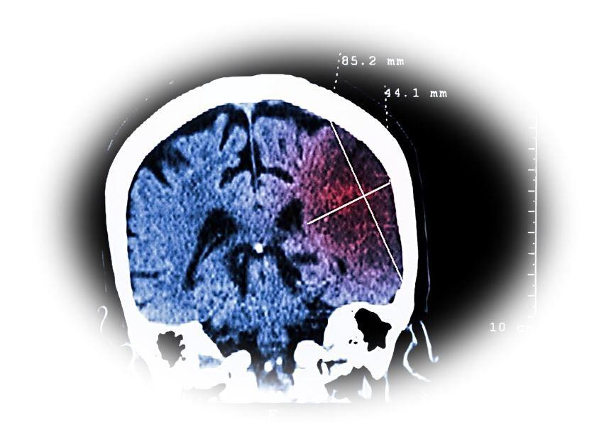  Stroke Mitigated by Even Low Levels of Physical Activity / image credit stroke: ©Puwadol Jaturawuttichai/shutterstock.com