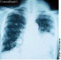 Renal Cell Carcinoma Metastases to the Lung