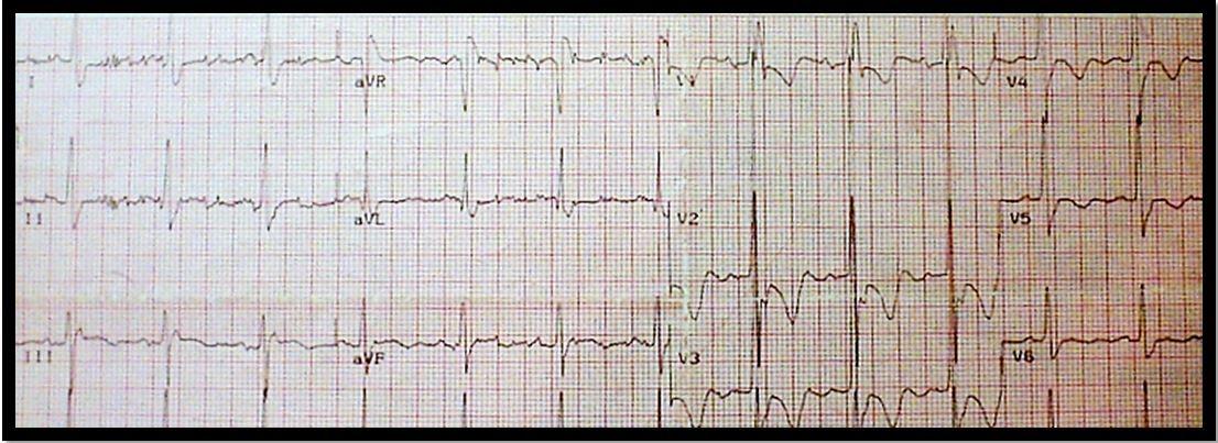 Pulmonary embolism 