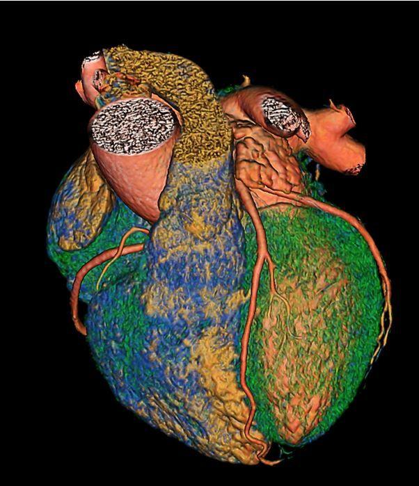  CHD Prevalence in US Shows No Significant Change, According to BRFSS Analysis