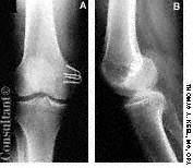 Medial Collateral Ligament Tear