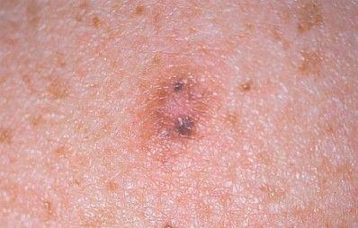 Melanoma-or Look-Alike?