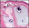 Scrotal Calcinosis