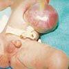 Omphalocele