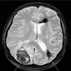 Intracranial Bleeding From Cerebral Amyloid Angiopathy