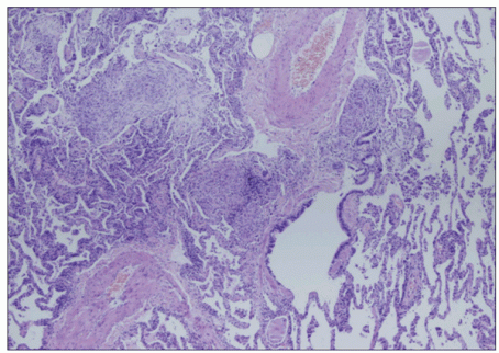 Drug induced lung disease